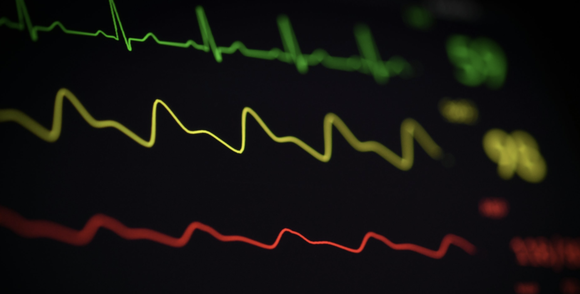 DSP and ML for Arrhythmia Classification